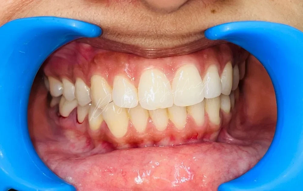 Frontal retracted intraoral photograph following posterior mandibular implant treatment
